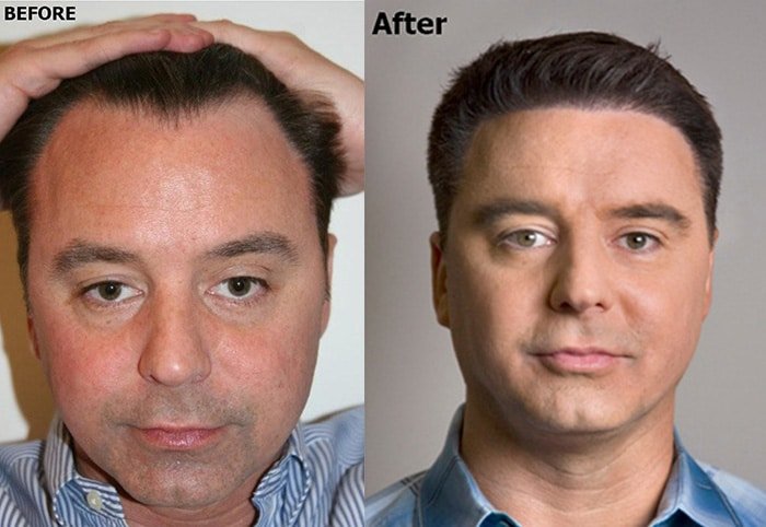 Hairline Redesign and Micro-FUE Planning
